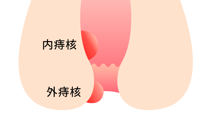 痔核（いぼ痔）