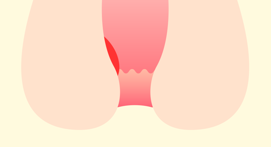 いぼ痔（内痔核）を固めて小さくする